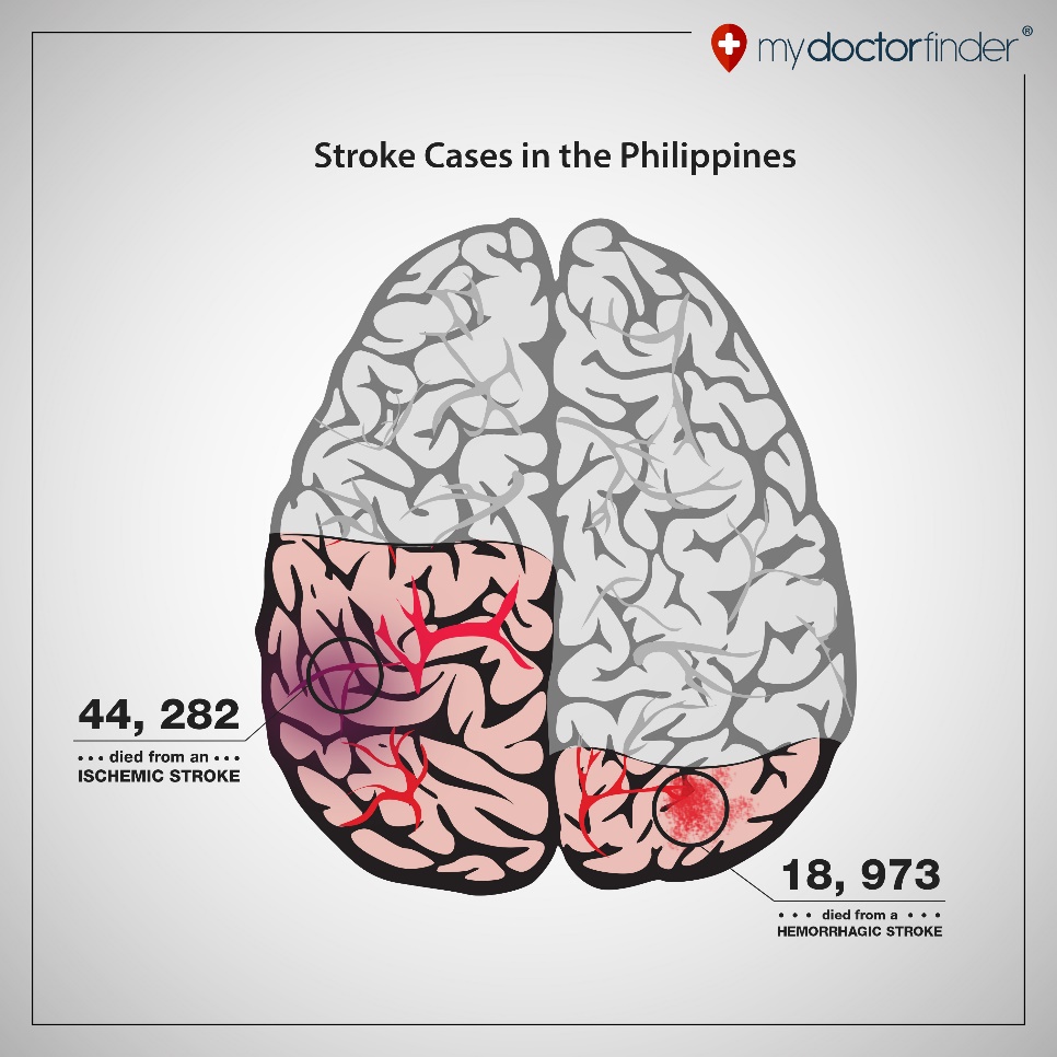 5 Signs of Stroke