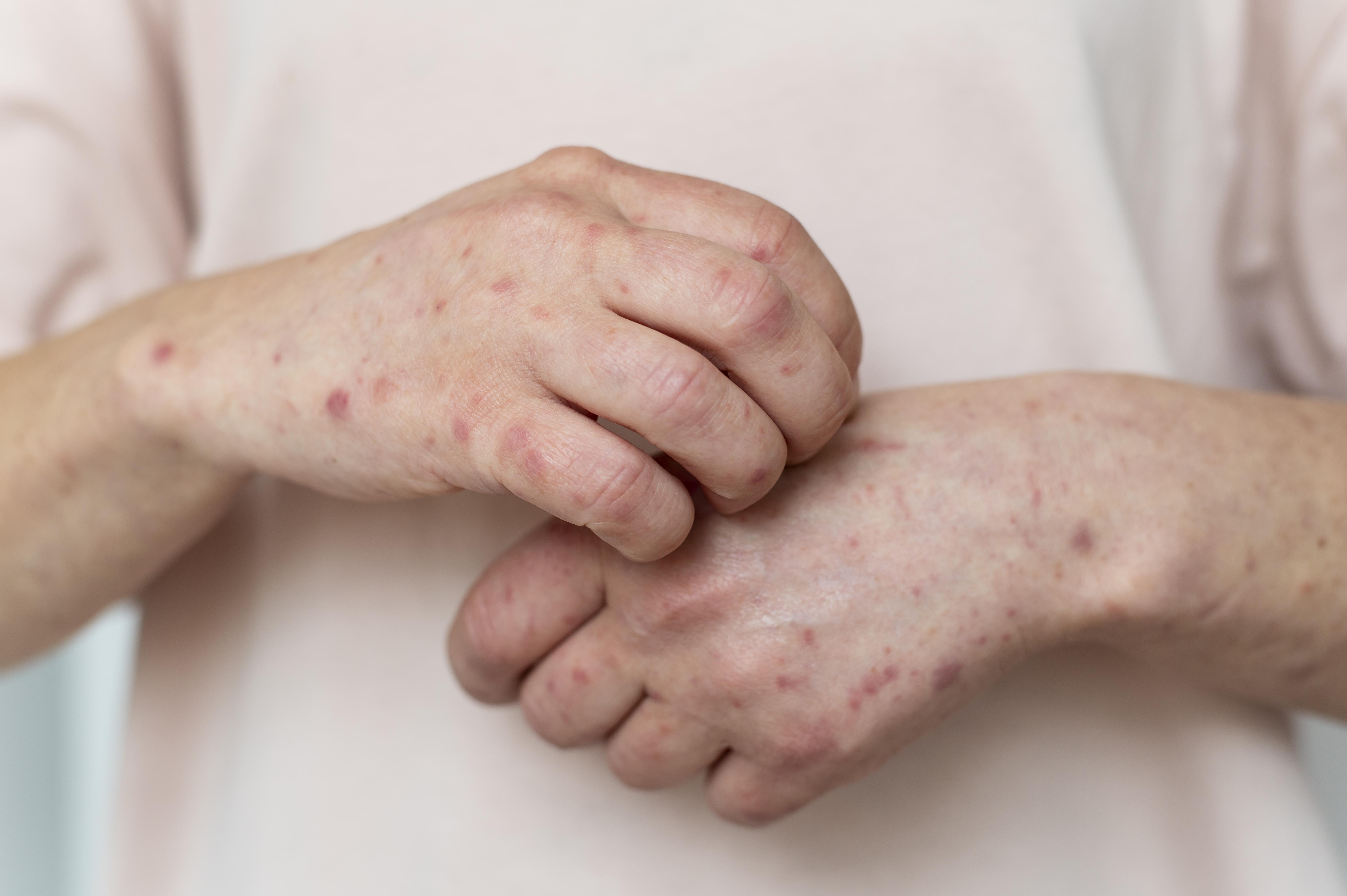 10-common-types-of-skin-rash-and-treatments